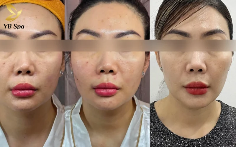 Review trải nghiệm LinearZ - Giải pháp trẻ hóa da không xâm lấn được tin chọn 24 Review trải nghiệm LinearZ thực tế từ khách hàng