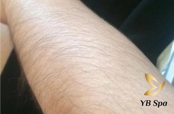 Lông tay khiến bạn tự ti như thế nào? Và sai lầm phổ biến về triệt lông tay (Nguồn: Internet)