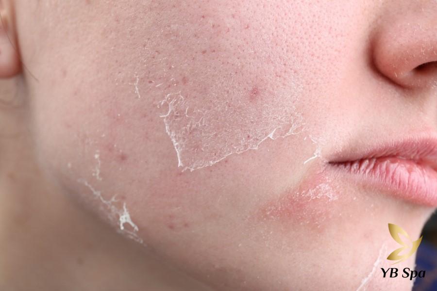 Peel da là gì? Top 8 sản phẩm peel da body tốt được ưa chuộng 26 Đang loại bỏ lớp da biểu bì trên mặt