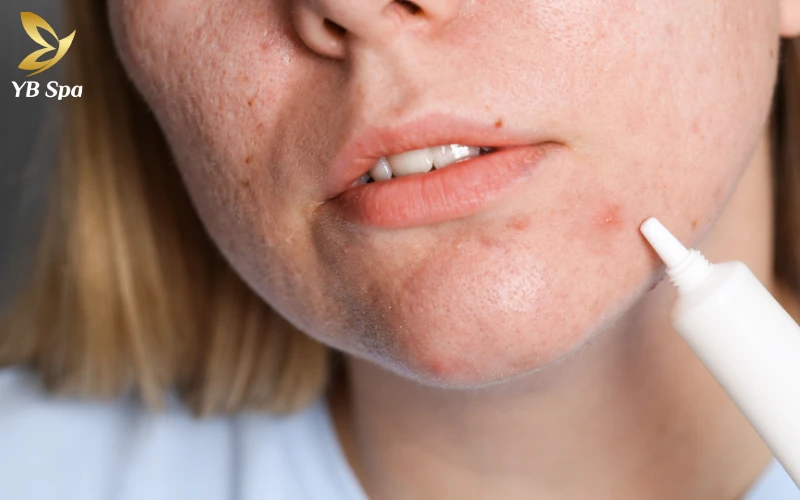 sản phẩm trị mụn hiệu quả