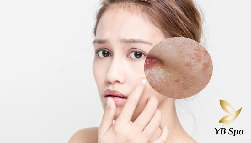 sau khi đốt mụn thịt nên bôi thuốc gì