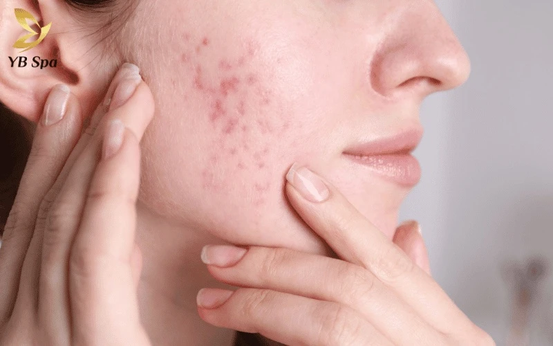 Chăm sóc da đúng cách sau LinearZ là chìa khóa để giữ vững hàng rào bảo vệ, ngăn chặn vi khuẩn xâm nhập gây mụn viêm.