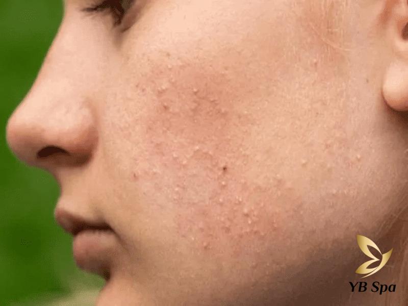 Tại sao sau khi Peel da bị thâm? Cách phục hồi da sau Peel 23 Nổi mụn là dấu hiệu cho thấy da bạn có thể đã bị bội nhiễm hoặc bị nấm da sau peel.