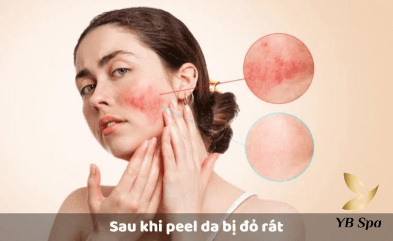Tại sao sau khi Peel da bị thâm? Cách phục hồi da sau Peel 24 bỏng rộp do sử dụng sai nồng độ hoạt chất hóa học hoặc để các hoạt chất lưu trên da quá thời gian cho phép.