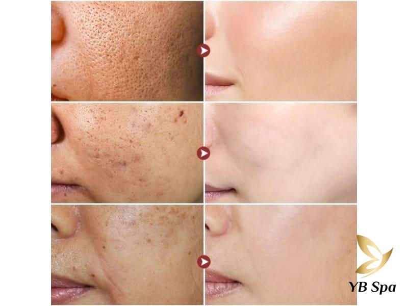Sau khi Meso kiêng ăn gì? Kiêng trong vòng bao lâu? 21 Meso, hay mesotherapy, là một phương pháp làm đẹp không can thiệp phẫu thuật