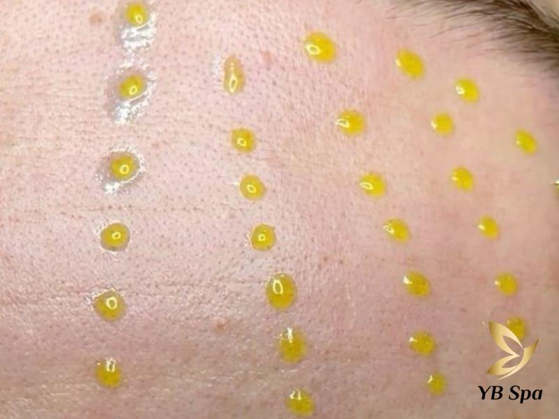 Sau khi Meso kiêng ăn gì? Kiêng trong vòng bao lâu? 22 phương pháp Meso cũng có những ưu và nhược điểm riêng