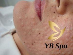 Sau khi Meso kiêng ăn gì? Kiêng trong vòng bao lâu? 