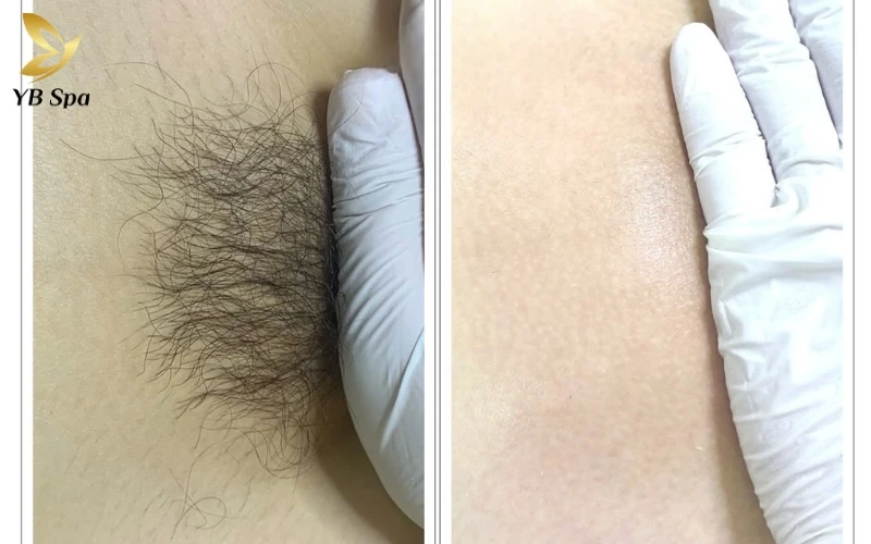 Hình ảnh sau khi triệt lông vùng kín và timeline thay đổi của da sau triệt lông 12 Hình ảnh sau khi triệt lông vùng kín Cận cảnh làn da ngay sau buổi đầu với các nốt sần hồng nhạt – dấu hiệu cho thấy nang lông đã bị tách rời khỏi nguồn nuôi dưỡng