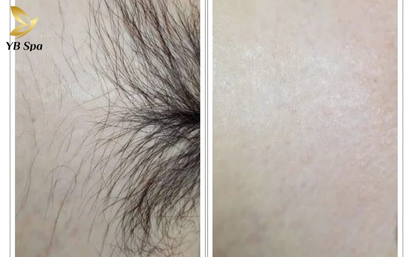 Hình ảnh sau khi triệt lông vùng kín và timeline thay đổi của da sau triệt lông 15 Tình trạng đỏ nhẹ trong 24 giờ đầu là phản ứng quang nhiệt bình thường, cho thấy Laser đã tác động sâu vào vùng hạ bì
