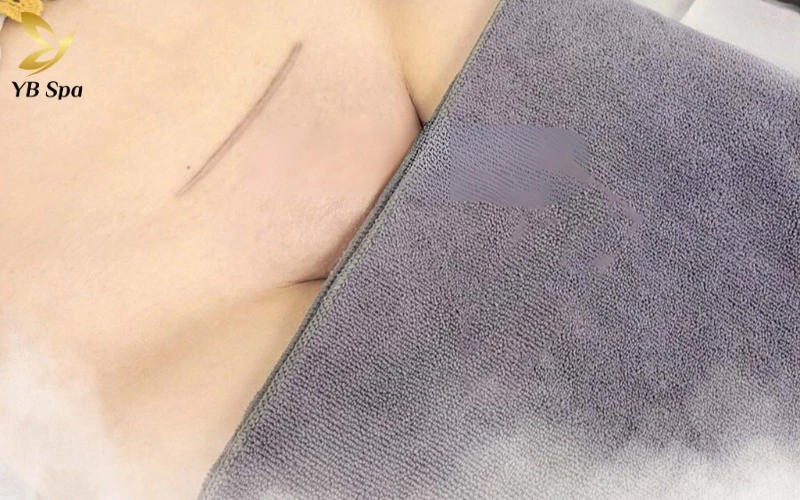 Hình ảnh sau khi triệt lông vùng kín và timeline thay đổi của da sau triệt lông 17 Làn da mịn màng như da em bé là kết quả của việc loại bỏ gốc lông đen kết hợp với cơ chế se khít lỗ chân lông tự nhiên