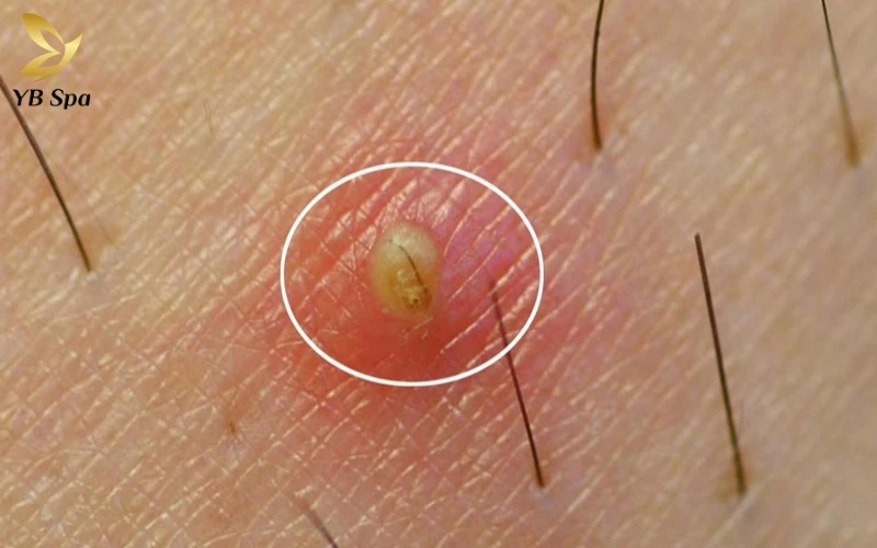 Hình ảnh sau khi triệt lông vùng kín và timeline thay đổi của da sau triệt lông 18 Tình trạng viêm nang lông (Folliculitis) thường xảy ra khi vi khuẩn xâm nhập vào các nang lông đang trong giai đoạn nhạy cảm