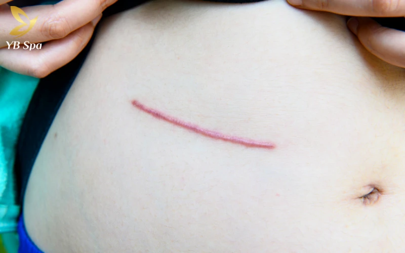 Sẹo lồi bị ngứa phải làm sao? Các phương pháp giảm ngứa tức thì tại nhà 26 Sẹo lồi bị ngứa phải làm sao