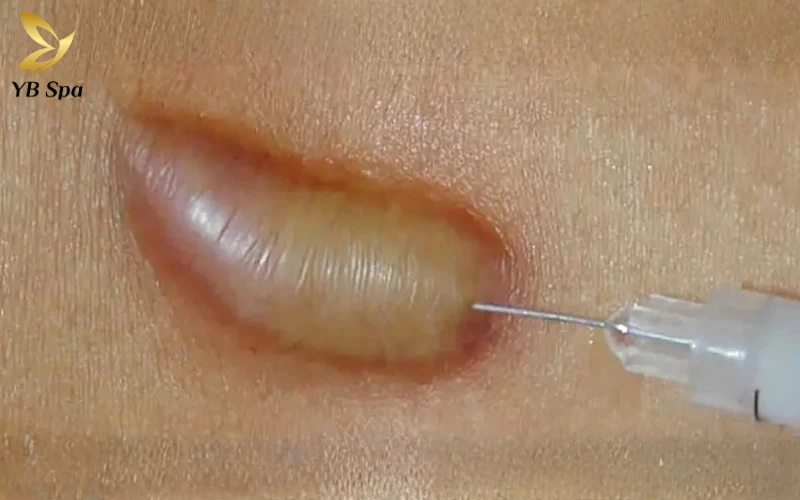 Sẹo lồi bị ngứa phải làm sao? Các phương pháp giảm ngứa tức thì tại nhà 32 Tiêm Corticosteroid