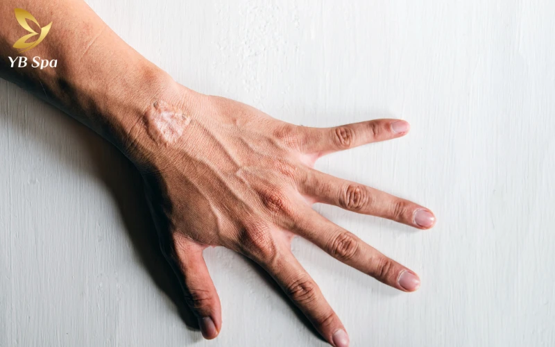 Sẹo lồi có tự hết không? Giải mã nguyên nhân và phương pháp điều trị 23 Sẹo lồi