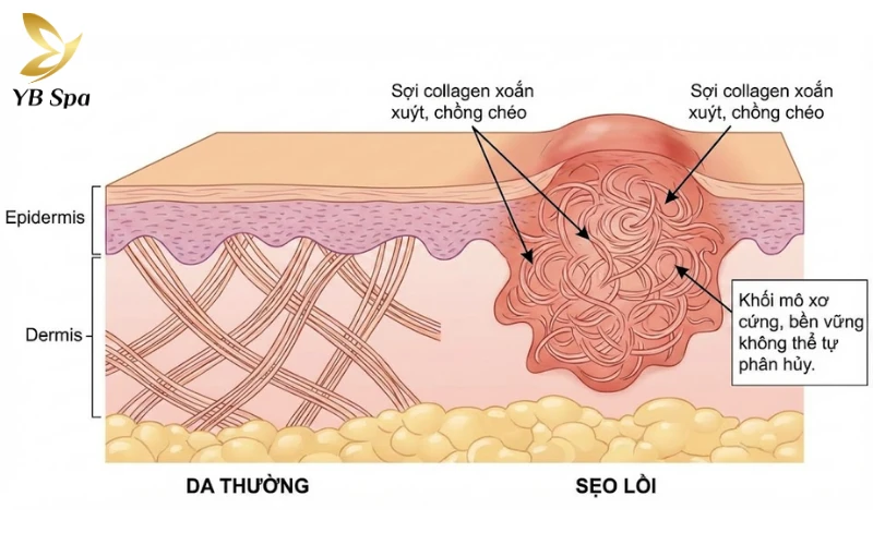Sẹo lồi có tự hết không? Giải mã nguyên nhân và phương pháp điều trị 25 Cấu trúc Collagen của sẹo lồi