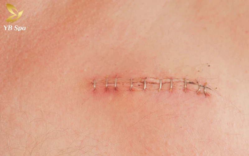 Sẹo lồi có tự hết không? Giải mã nguyên nhân và phương pháp điều trị 26 Sẹo lồi có tự hết không? Giải mã nguyên nhân và phương pháp điều trị