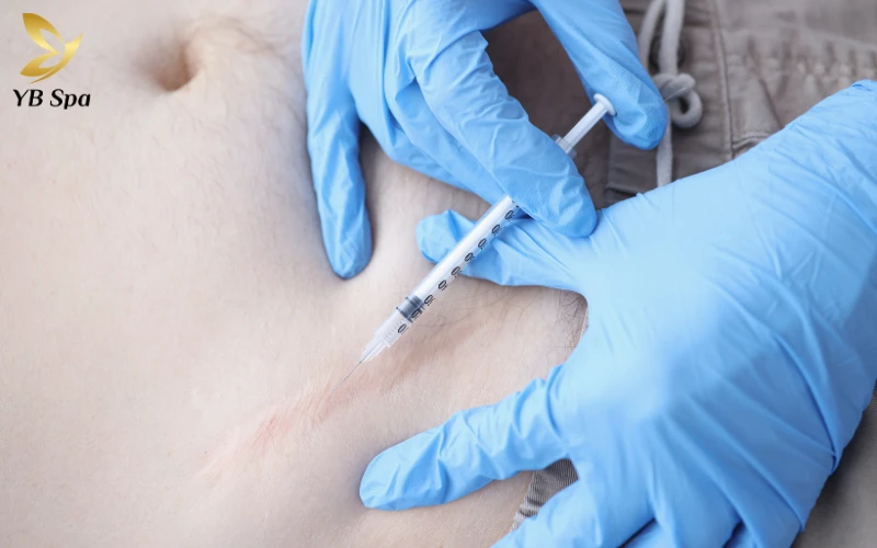 Sẹo lồi có tự hết không? Giải mã nguyên nhân và phương pháp điều trị 28 Điều trị nội khoa sẹo lồi