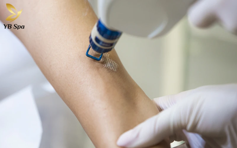 Sẹo lồi có tự hết không? Giải mã nguyên nhân và phương pháp điều trị 30 Công nghệ Laser (Laser CO2 Fractional, Laser PDL)