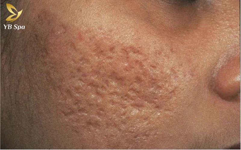 Sẹo lõm lâu năm có trị được không? 24 Sẹo lõm