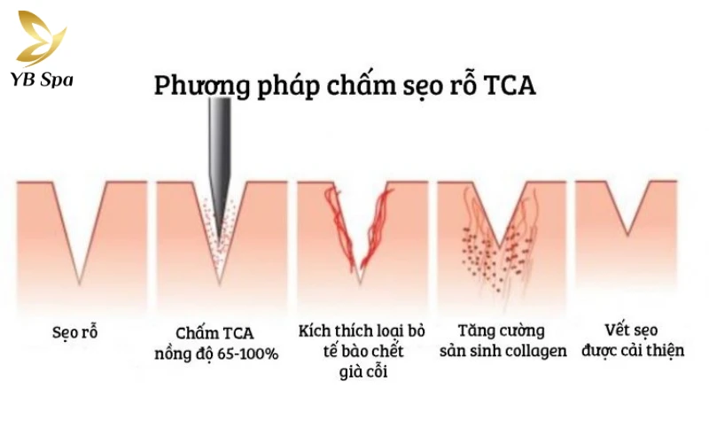 Sẹo lõm lâu năm có trị được không? 33 Phương pháp chấm TCA (TCA Cross)