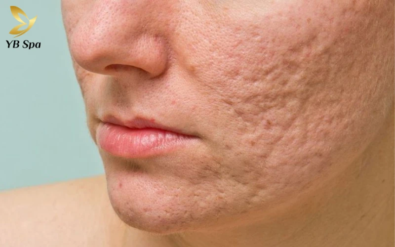 Sẹo lõm lâu năm có trị được không? 25 Sẹo lõm lâu năm có trị được không?