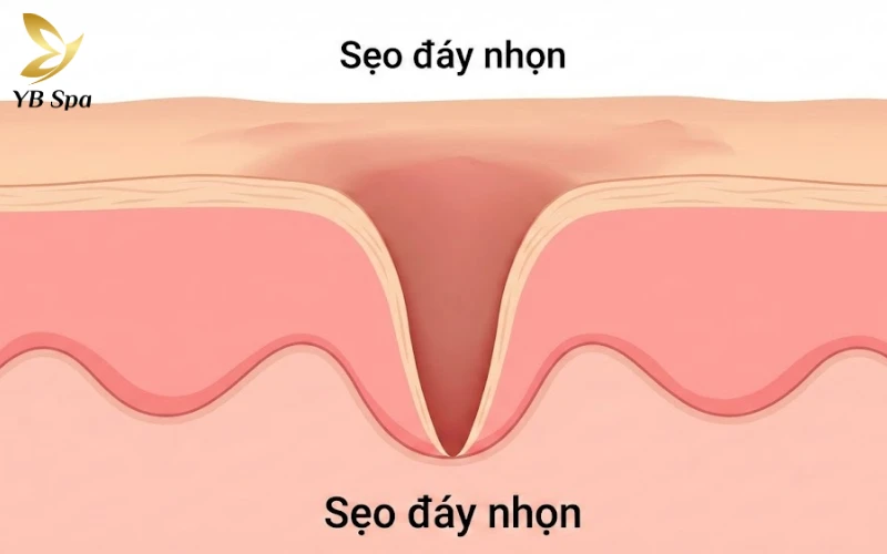 Sẹo lõm lâu năm có trị được không? 26 Sẹo đáy nhọn (Ice Pick Scar)