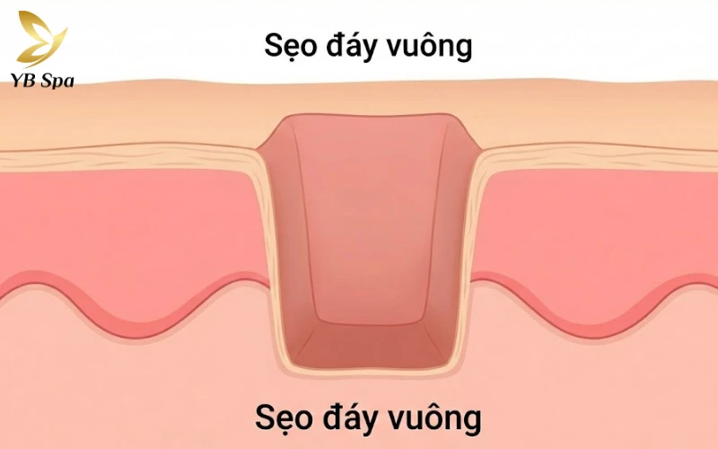 Sẹo lõm lâu năm có trị được không? 27 Sẹo đáy vuông (Boxcar Scar)