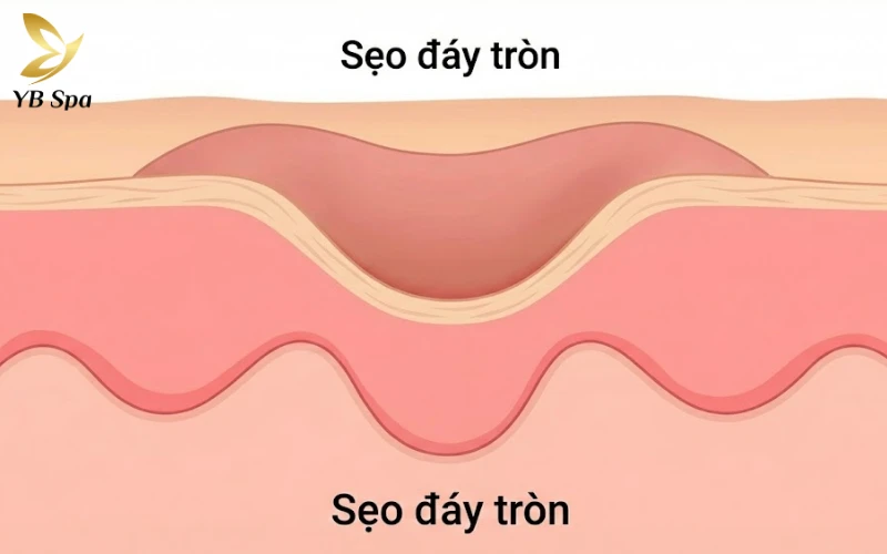 Sẹo lõm lâu năm có trị được không? 28 Sẹo đáy tròn (Rolling Scar)