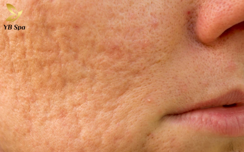 Sẹo lõm lâu năm có trị được không? 29 Sẹo lõm lâu năm có trị được không