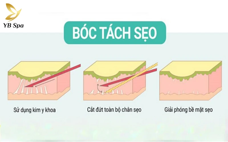 Sẹo lõm lâu năm có trị được không? 30 Bóc tách đáy sẹo (Subcision)
