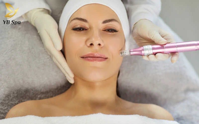 Sẹo lõm lâu năm có trị được không? 32 Công nghệ Lăn kim / Phi kim (Microneedling)
