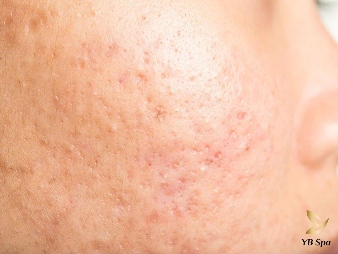Sẹo mụn có tự hết không? Các phòng ngừa sẹo mụn hình thành 20 Sẹo mụn có tự hết không? Câu trả lời cho vấn đề này phụ thuộc vào nhiều yếu tố như loại sẹo, tình trạng da