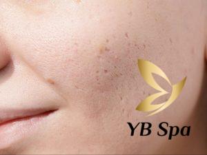 Sẹo mụn có tự hết không? Các phòng ngừa sẹo mụn hình thành