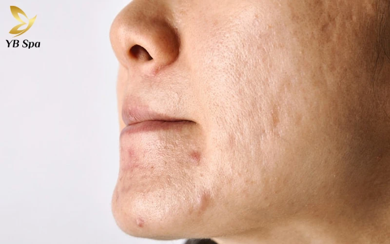 Sẹo rỗ có tự hết không? Tại sao điều trị sẹo rỗ thất bại? 22 Sẹo rỗ có tự hết không