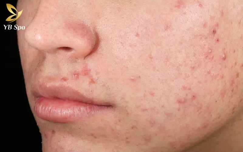 Sẹo rỗ có tự hết không? Tại sao điều trị sẹo rỗ thất bại? 24 Khả năng tự cải thiện tự nhiên (Mức độ Nhẹ)