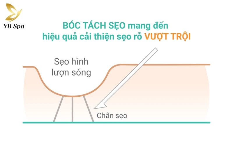 Sẹo rỗ có tự hết không? Tại sao điều trị sẹo rỗ thất bại? 25 Kỹ thuật subcision (cắt đáy sẹo)