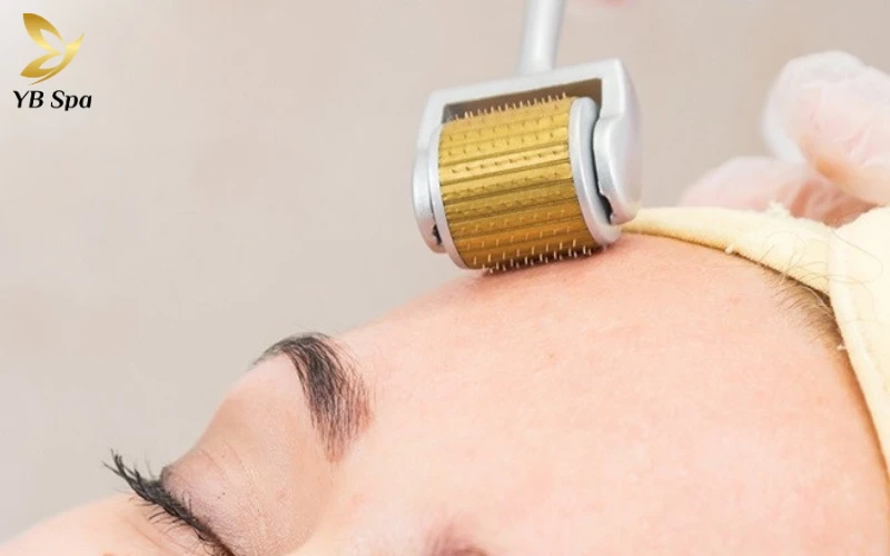 Sẹo rỗ có tự hết không? Tại sao điều trị sẹo rỗ thất bại? 26 Lăn Kim/Phi Kim (Microneedling)