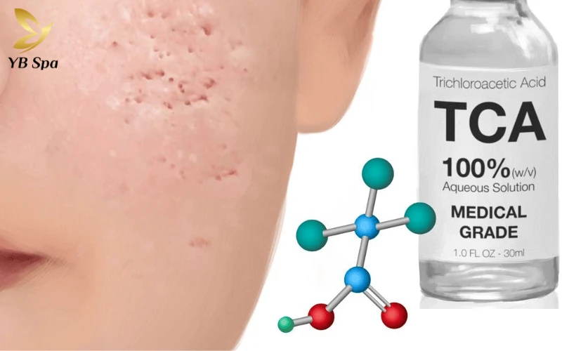 Sẹo rỗ có tự hết không? Tại sao điều trị sẹo rỗ thất bại? 27 Công Nghệ TCA CROSS