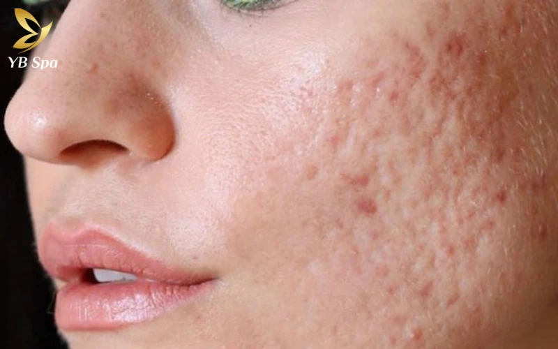 Sẹo rỗ có tự hết không? Tại sao điều trị sẹo rỗ thất bại? 29 Yếu tố cơ địa đáp ứng kém