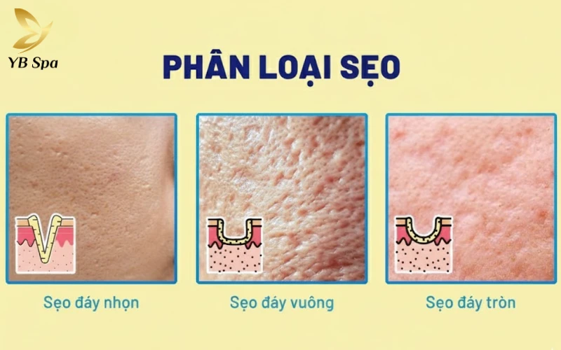 Phân loại các loại sẹo rỗ