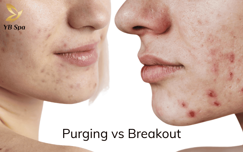 Đẩy mụn (Purging) là phản ứng tất yếu khi dùng AHA/BHA, mụn chỉ nổi ở vùng da quen thuộc và gom cồi rất nhanh