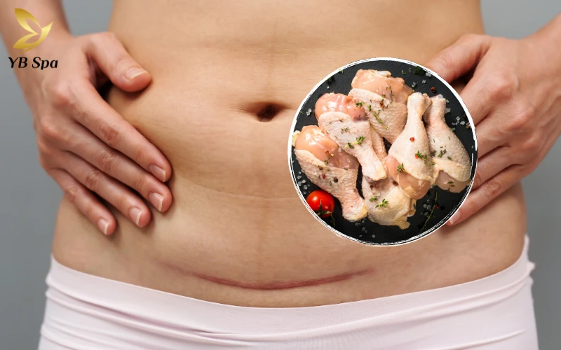 Sinh mổ ăn thịt gà có bị sẹo lồi không