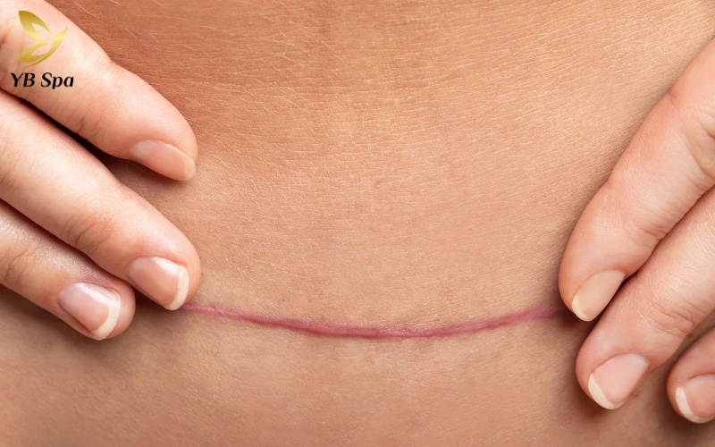 Sinh mổ ăn thịt gà có bị sẹo lồi không trả lời theo Quan niệm dân gian