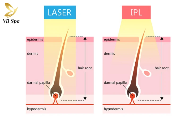 so sánh công nghệ triệt lông diode laser và IPL, Cùng YB Spa phân tích sự khác biệt giữa Diode Laser và IPL để tìm ra giải pháp triệt lông phù hợp và hiệu quả nhất cho làn da của bạn