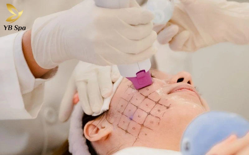 Thermage giúp cải thiện nếp nhăn và đường nét khuôn mặt rõ rệt.