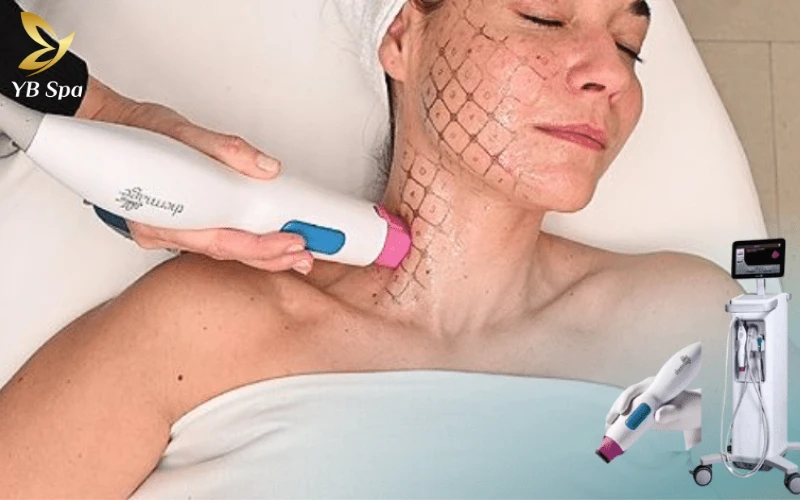 Thermage phù hợp với nhiều đối tượng muốn cải thiện các vấn đề lão hóa da