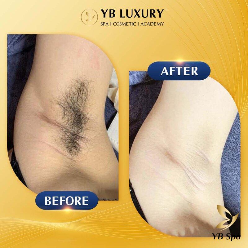 Trước và sau khi triệt lông bằng công nghệ cao tại YB Spa (Nguồn: Internet)