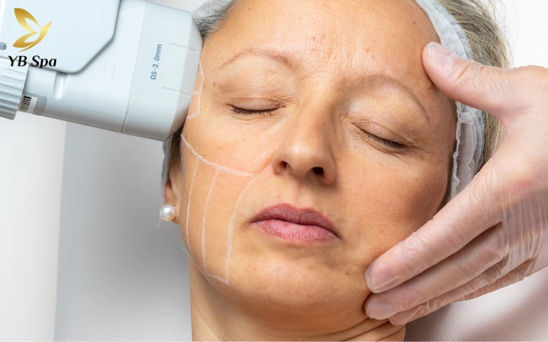 So sánh LinearZ và HIFU: giống nhau, khác nhau thế nào? 20 So sánh LinearZ và HIFU