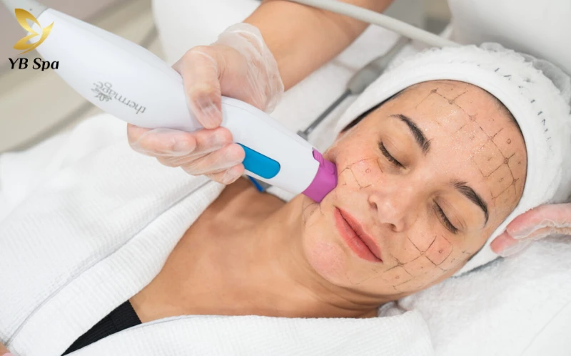 So sánh LinearZ và HIFU: giống nhau, khác nhau thế nào? 23 Thermage – Sóng RF đơn cực