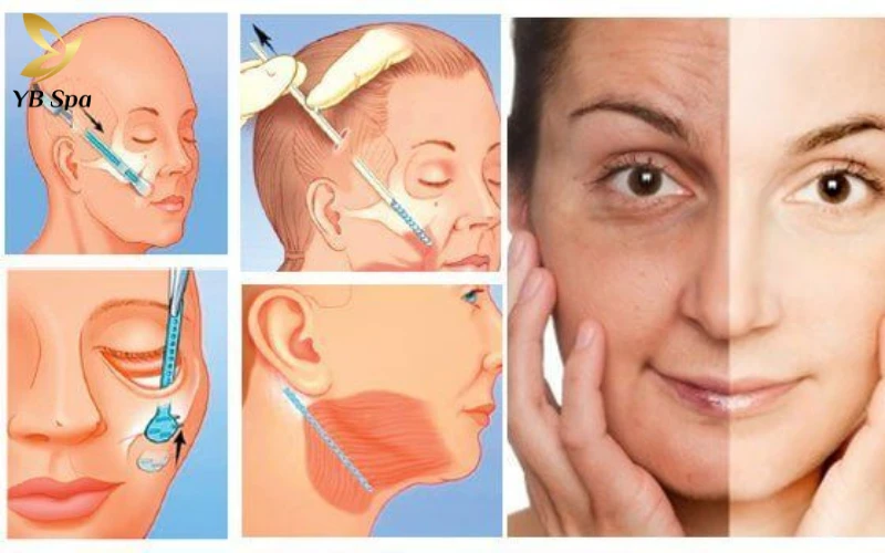 So sánh LinearZ và HIFU: giống nhau, khác nhau thế nào? 25 Phẫu thuật căng da mặt